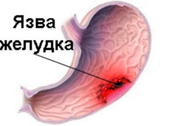 Язва желудка: симптомы, лечение и профилактика