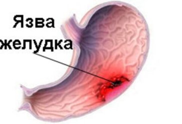 Язва желудка: симптомы, лечение и профилактика