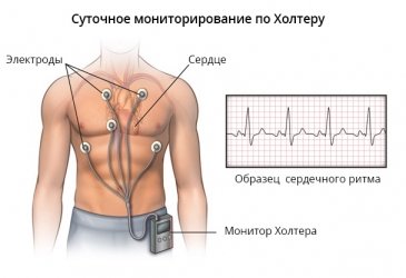 Мы делаем суточное мониторирование по Холтеру