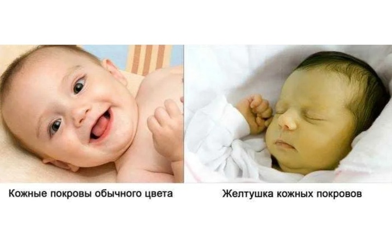 Желтуха у новорожденного