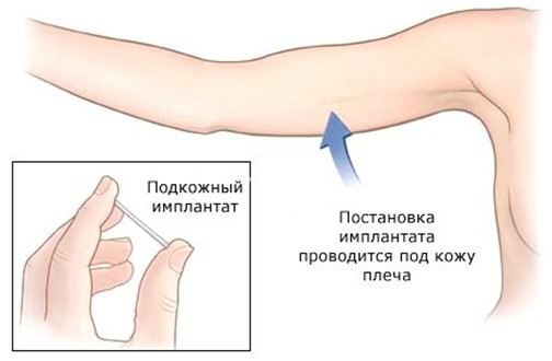 Импланон