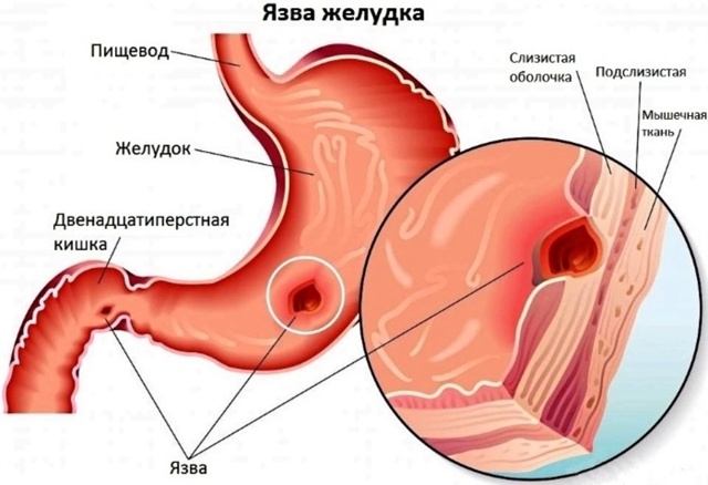 Язвенный дефект на слизистой оболочке желудка